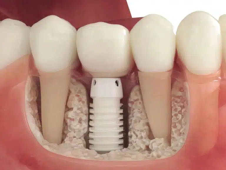 Zirconia-implant