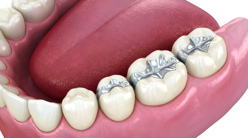 3D Dental Illustration of Lower Molars with Silver Fillings and Tongue Anatomy