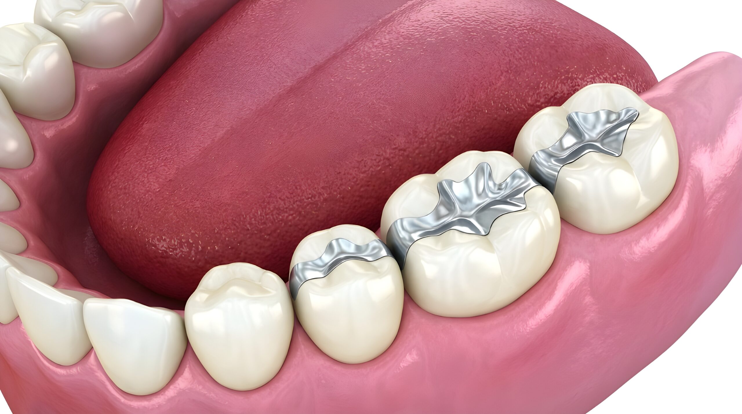 3D Dental Illustration of Lower Molars with Silver Fillings and Tongue Anatomy
