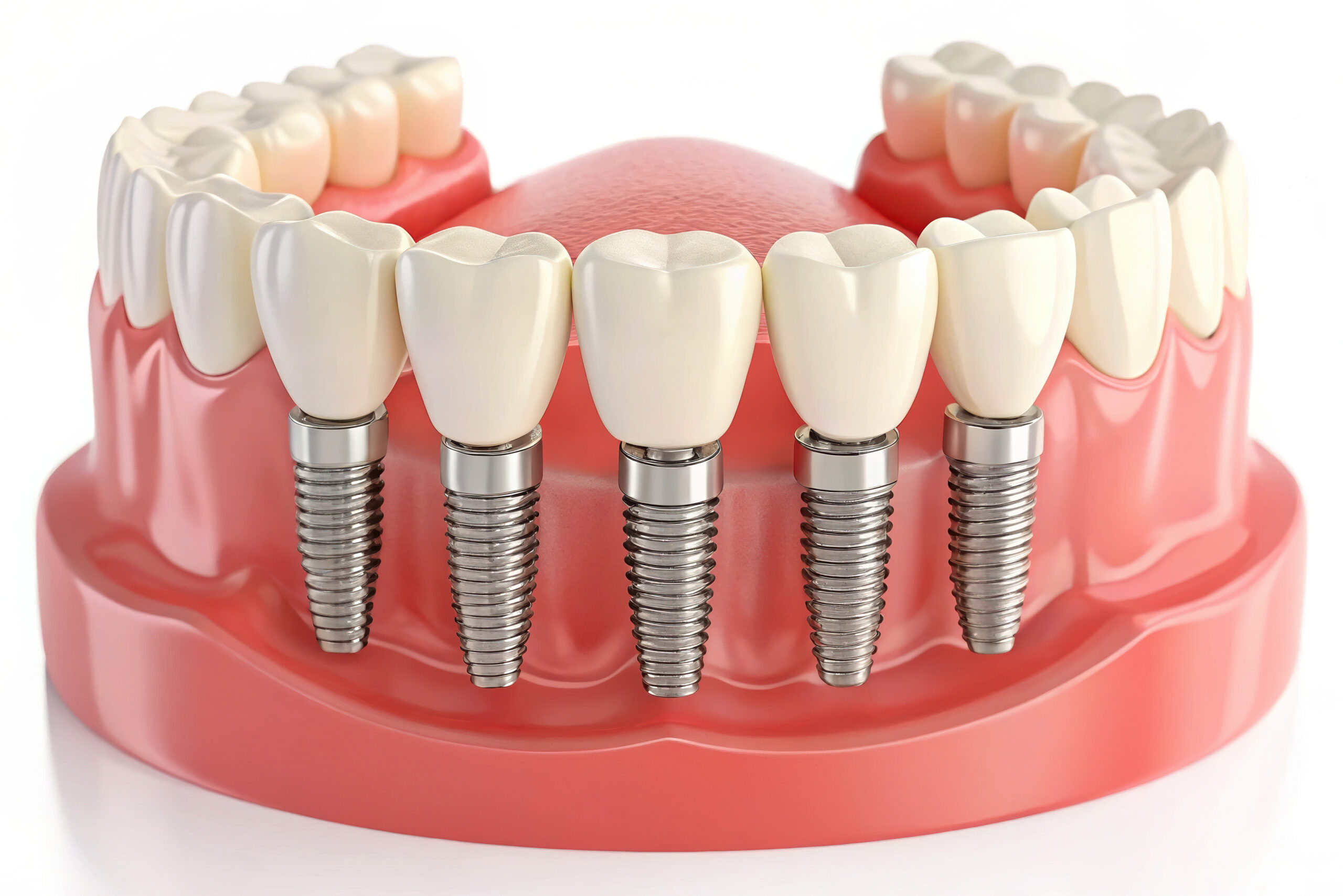 dental implants