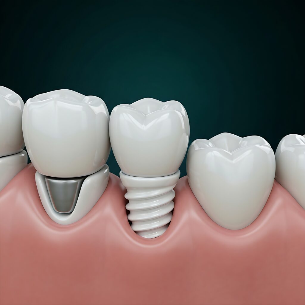 a white Zirconia dental implant. A ceramic screw and white abutment integrated into the jawbone with a translucent porcelain incisor crown. Natural neighboring teeth, healthy gums, dark teal studio l